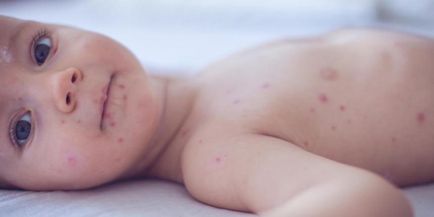 Waterpokken bij je baby: symptomen en behandeling
