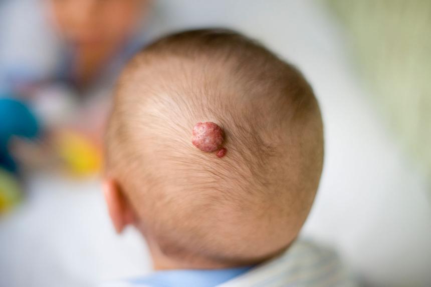 Aardbeienvlek (hemangioom) bij je baby Aardbeienvlek (hemangioom) bij je baby