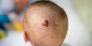 Aardbeienvlek (hemangioom) bij je baby