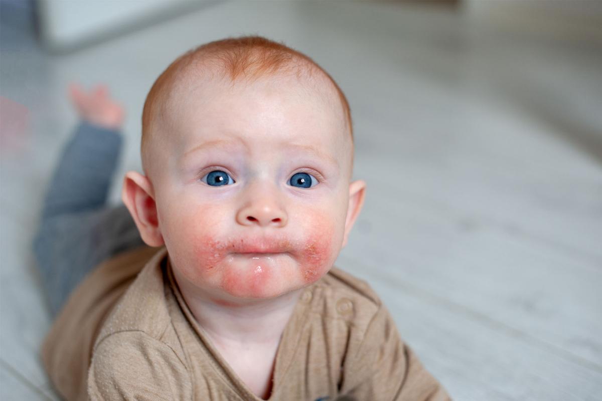 Atopisch eczeem: chronisch eczeem bij je baby