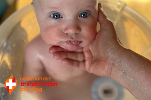 Tips van de Nederlandse Brandwondenstichting Tips van de Nederlandse Brandwondenstichting