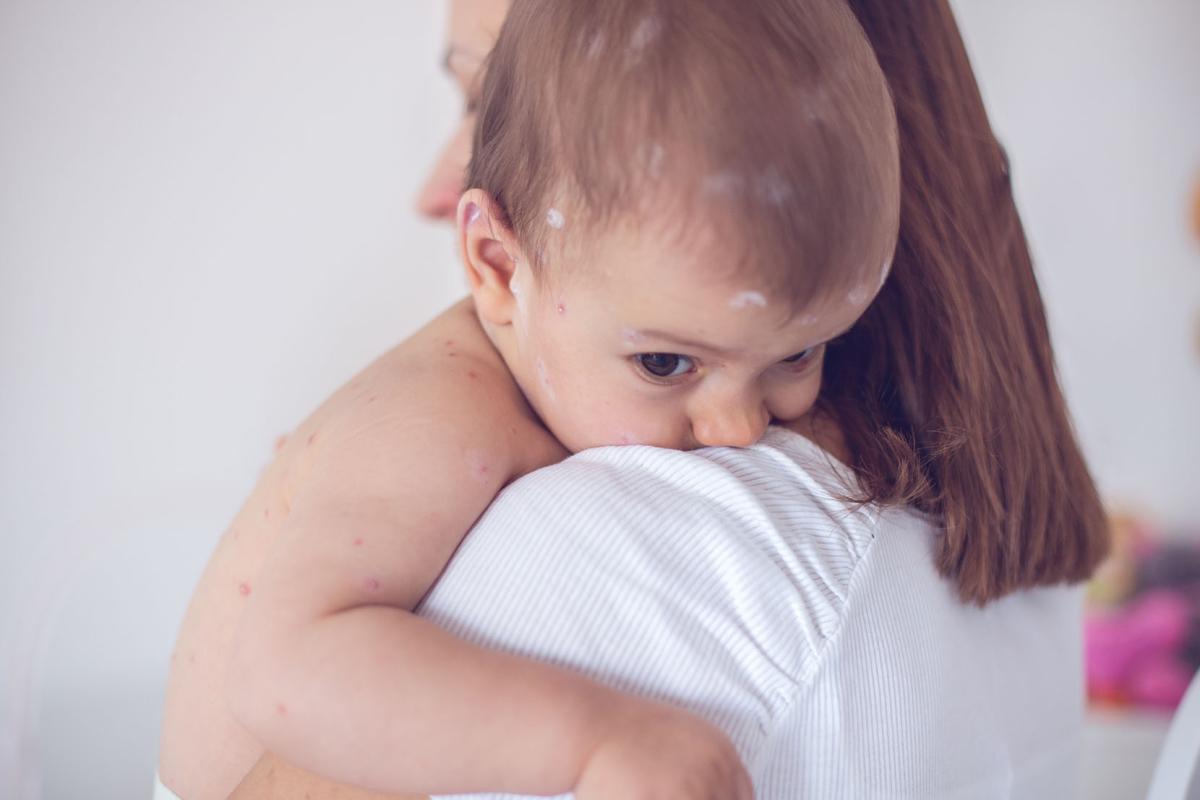 Tips bij allergisch gerelateerde huidproblemen bij baby's