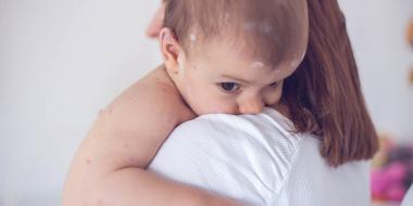 Tips bij allergisch gerelateerde huidproblemen bij baby's