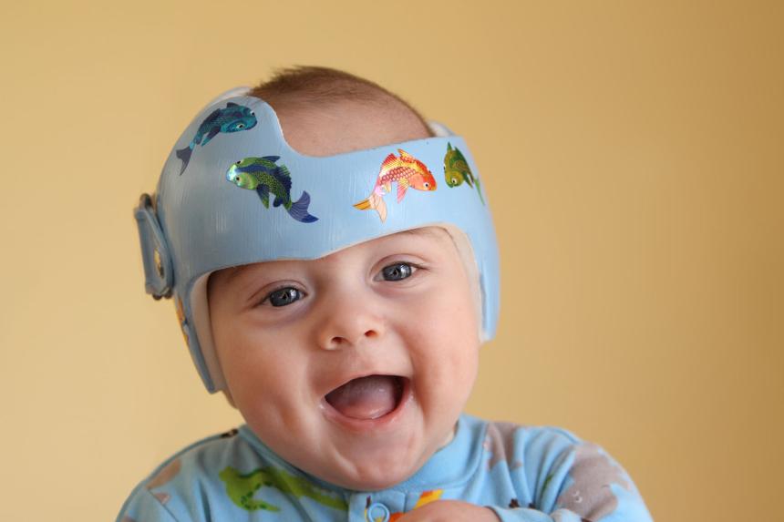 Een baby met redressiehelm Een baby met redressiehelm
