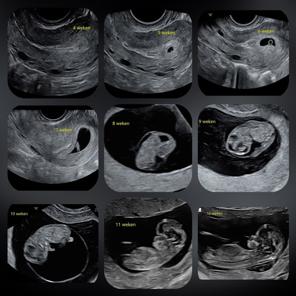 Echo baby eerste 12 weken
