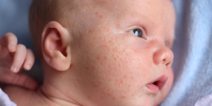 Baby acne: oorzaken en behandelingen 