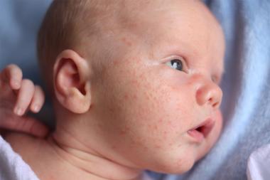 Baby acne: zo herken je het