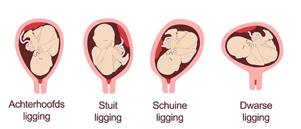 baby-baarmoeder-ligging