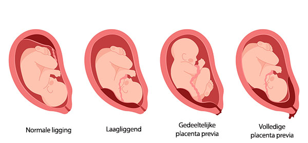 placenta-ligging