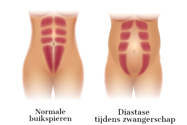 diastase-zwangerschap