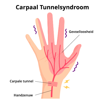 Carpaal Tunnelsyndroom