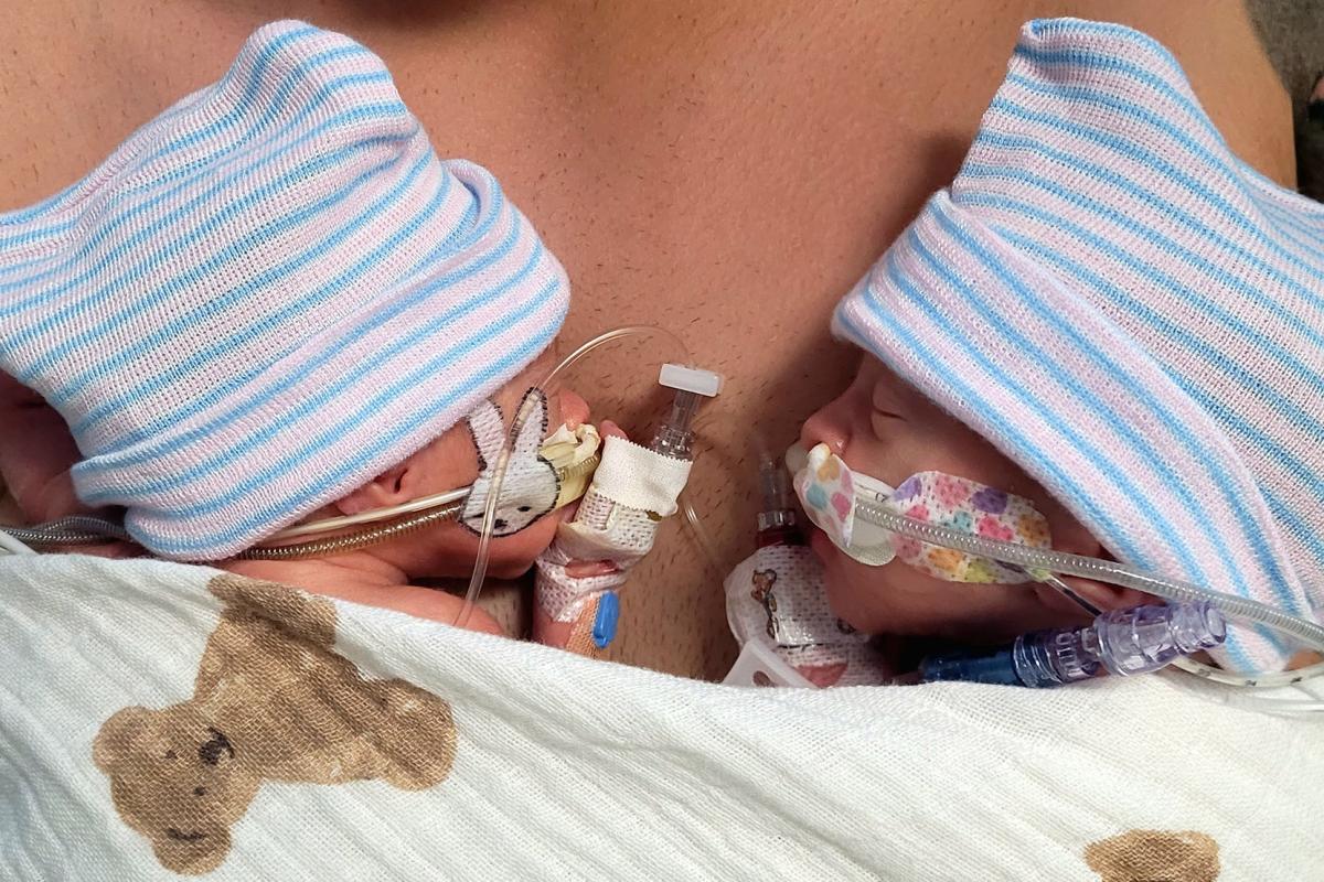 Kimberley was zwanger van een zeldzame mono-mono tweeling